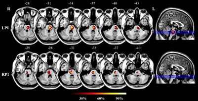 Widespread White Matter Microstructure Alterations Based on Diffusion Tensor Imaging and Diffusion Kurtosis Imaging in Patients With Pontine Infarction